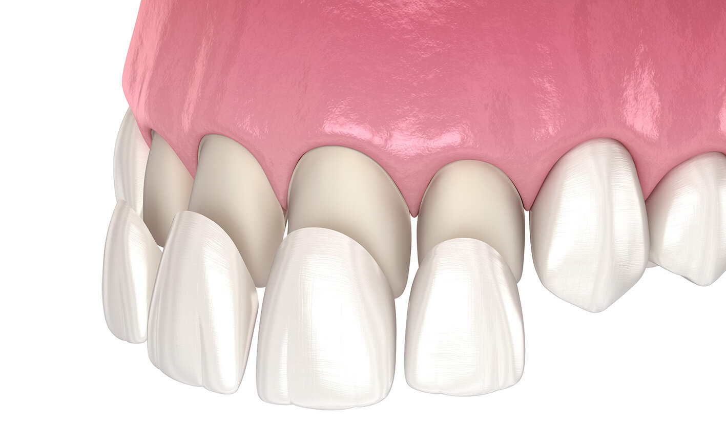Porcelain veneers