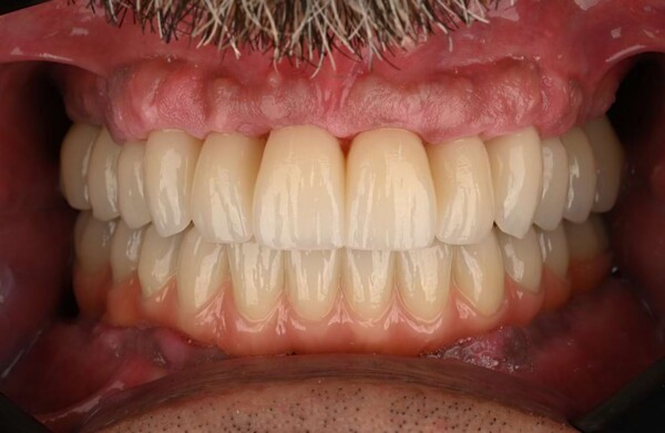 Before dental implants