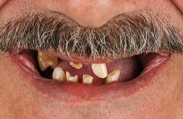 After dental implants