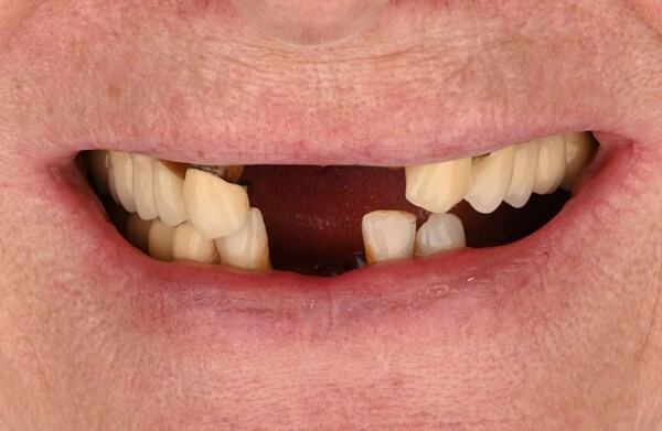 After dental implants