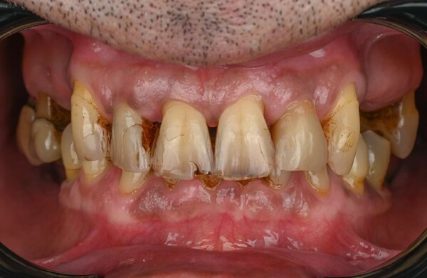 After dental implants