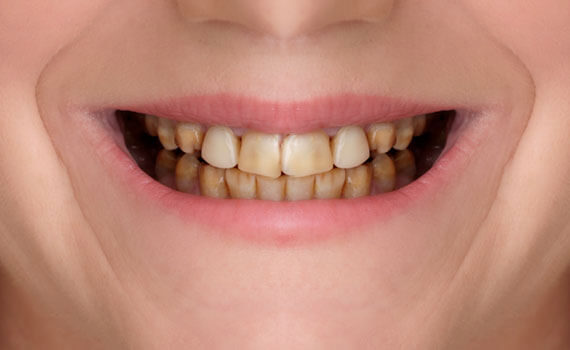 After dental implants